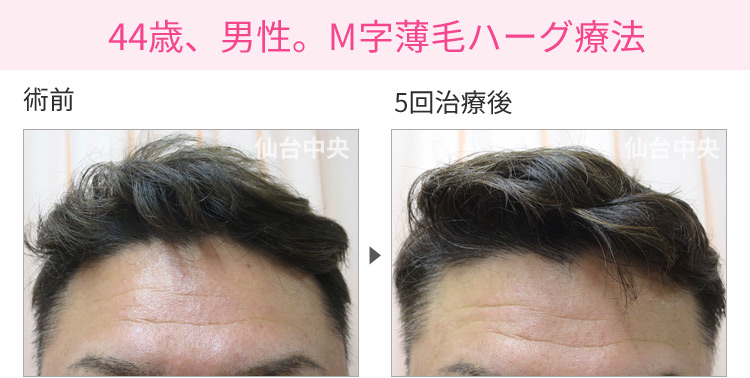 44歳、男性。M字薄毛ハーグ療法 症例写真1