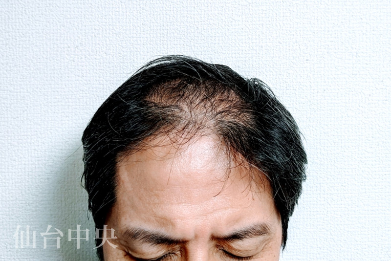 遺伝的要因により頭頂部の薄毛が認められる男性